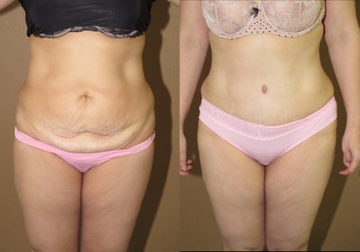 Case 2478 - Abdominoplasty and liposuction mommy makeover