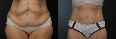 Case 2479 - 62 year old after abdominoplasty