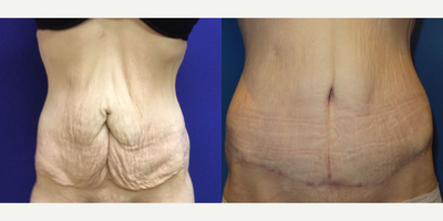 Case 248 - Woman treated with Tummy Tuck