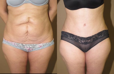 Case 2480 - Tummy tuck abdomnal wall reconstruction