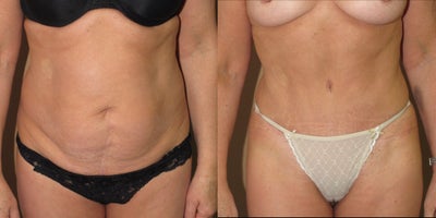 Case 2483 - Abdominoplasty/tummy tuck with liposuction