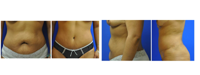 Case 2485 - abdomenoplasty