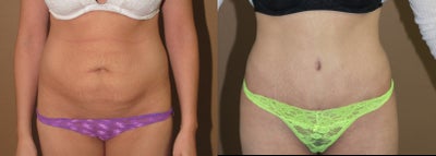 Case 2486 - Abdominoplasty