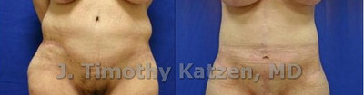Case 2487 - Vertical Abdominoplasty after massive weight loss