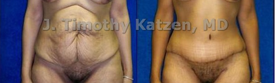 Case 2488 - Abdominoplasty after weight loss surgery