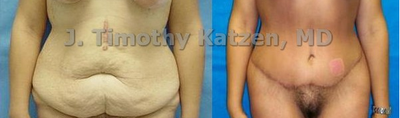 Case 2489 - Abdominoplasty after weight loss surgery