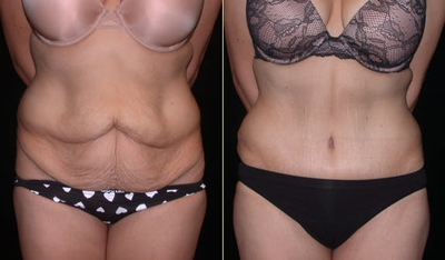 Case 2490 - Woman treated with Tummy Tuck