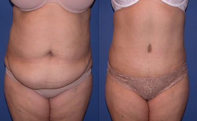 Case 2491 - Woman treated with Tummy Tuck