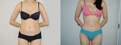 Case 2497 - Tummy Tuck