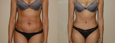Case 2498 - Tummy Tuck