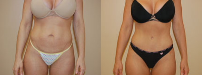 Case 2499 - Tummy Tuck