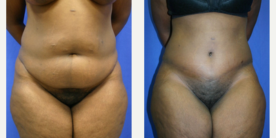 Case 25 - Woman treated with Tummy Tuck
