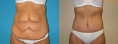 Case 2501 - Tummy Tuck