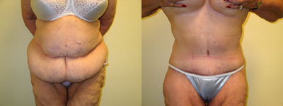 Case 2503 - Tummy Tuck