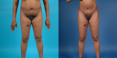 Case 2504 - abdominoplasty