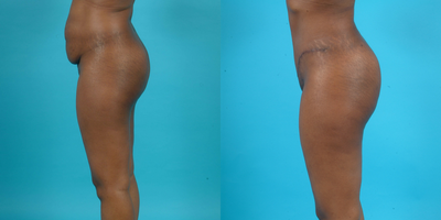 Case 2505 - abdominoplasty