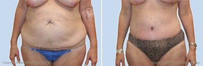 Case 2506 - tummy tuck