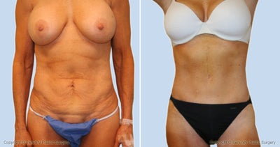 Case 2507 - tummy tuck