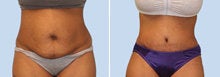 Case 2508 - Tummy tuck