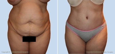 Case 2509 - tummy tuck