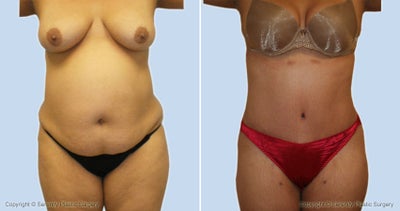 Case 2510 - Tummy Tuck