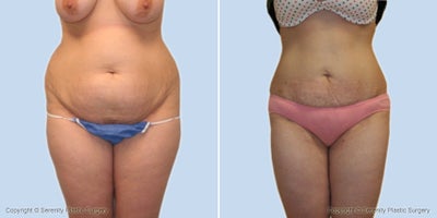 Case 2511 - Tummy tuck