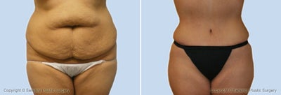 Case 2512 - tummy tuck