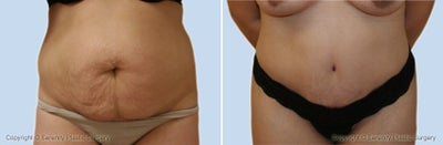 Case 2513 - tummy tuck