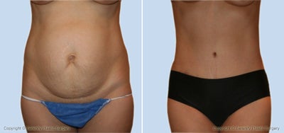 Case 2514 - Abdominoplasty