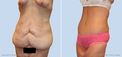 Case 2515 - Extended Abdominoplasty