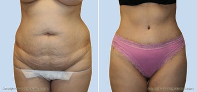 Case 2516 - Abdominoplasty