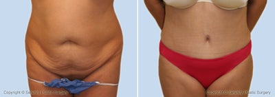 Case 2517 - Abdominoplasty