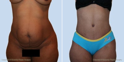 Case 2518 - Abdominoplasty