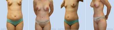 Case 2519 - Abdominoplasty