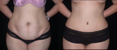Case 2521 - Tummy Tuck (abdominoplasty)
