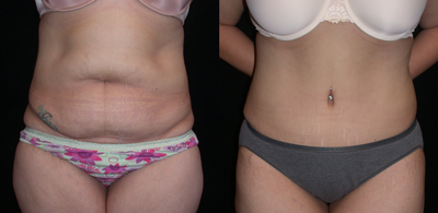 Case 2522 - Tummy Tuck