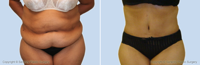 Case 2523 - Mommy Makeover