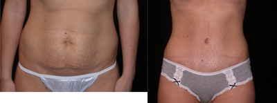 Case 2524 - Tummy tuck