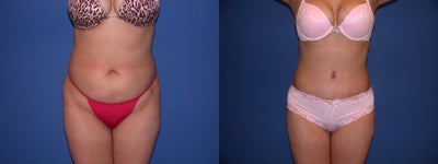 Case 2525 - Tummy tuck
