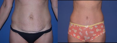 Case 2526 - Before & After Abdominoplasty