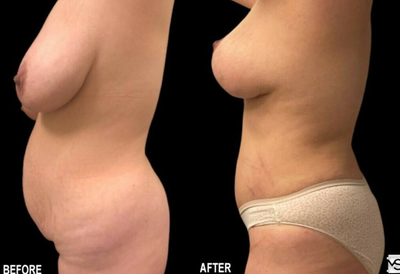 Case 2538 - 40 year old woman treated with Tummy Tuck