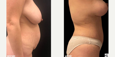 Case 2539 - 40 year old woman treated with Tummy Tuck