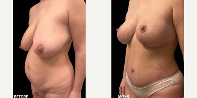 Case 2540 - 40 year old woman treated with Tummy Tuck