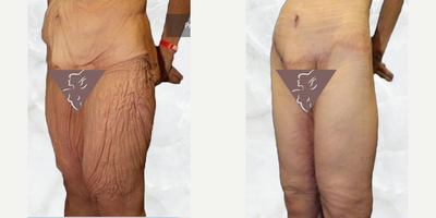 Case 2541 - 45-54 year old woman treated with Tummy Tuck, Thigh Lift