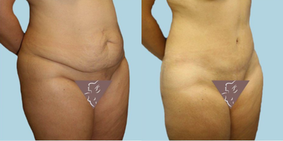 Case 2542 - 25-34 year old woman treated with Tummy Tuck