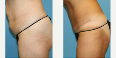 Case 2543 - Woman treated with Tummy Tuck