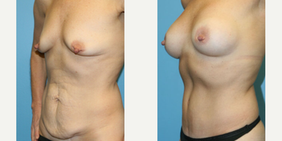 Case 2544 - Woman treated with Tummy Tuck