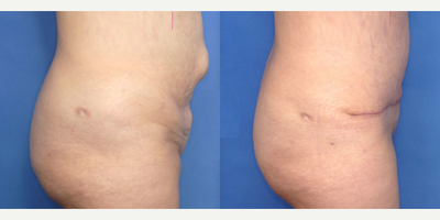 Case 2546 - 50 year old woman treated with Tummy Tuck