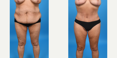 Case 256 - 35-44 year old woman treated with Tummy Tuck