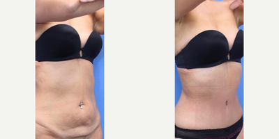 Case 2563 - Woman treated with Tummy Tuck